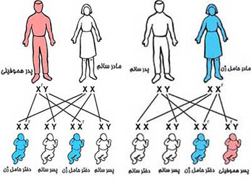 امکان تشخیص هموفیلی (اختلال انعقادی خون) قبل از تولد